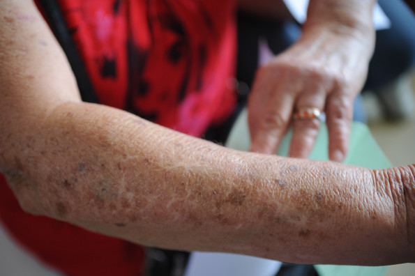Dermatologistas em todo o país participam de mutirão preventivo de câncer de pele